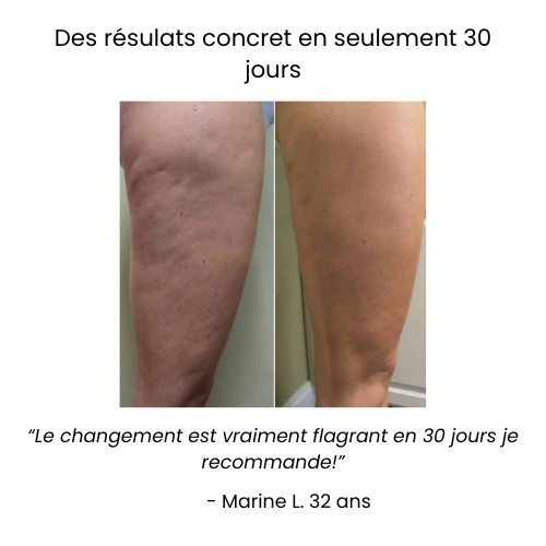 Ventouse Anti-Cellulite Électrique